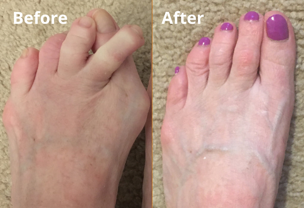 Bonex Bunion Corrector