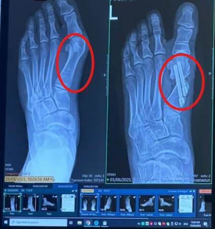 Bonex Bunion Corrector
