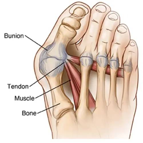 Bonex Bunion Corrector