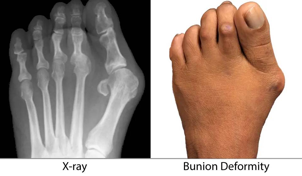 Bonex Bunion Corrector