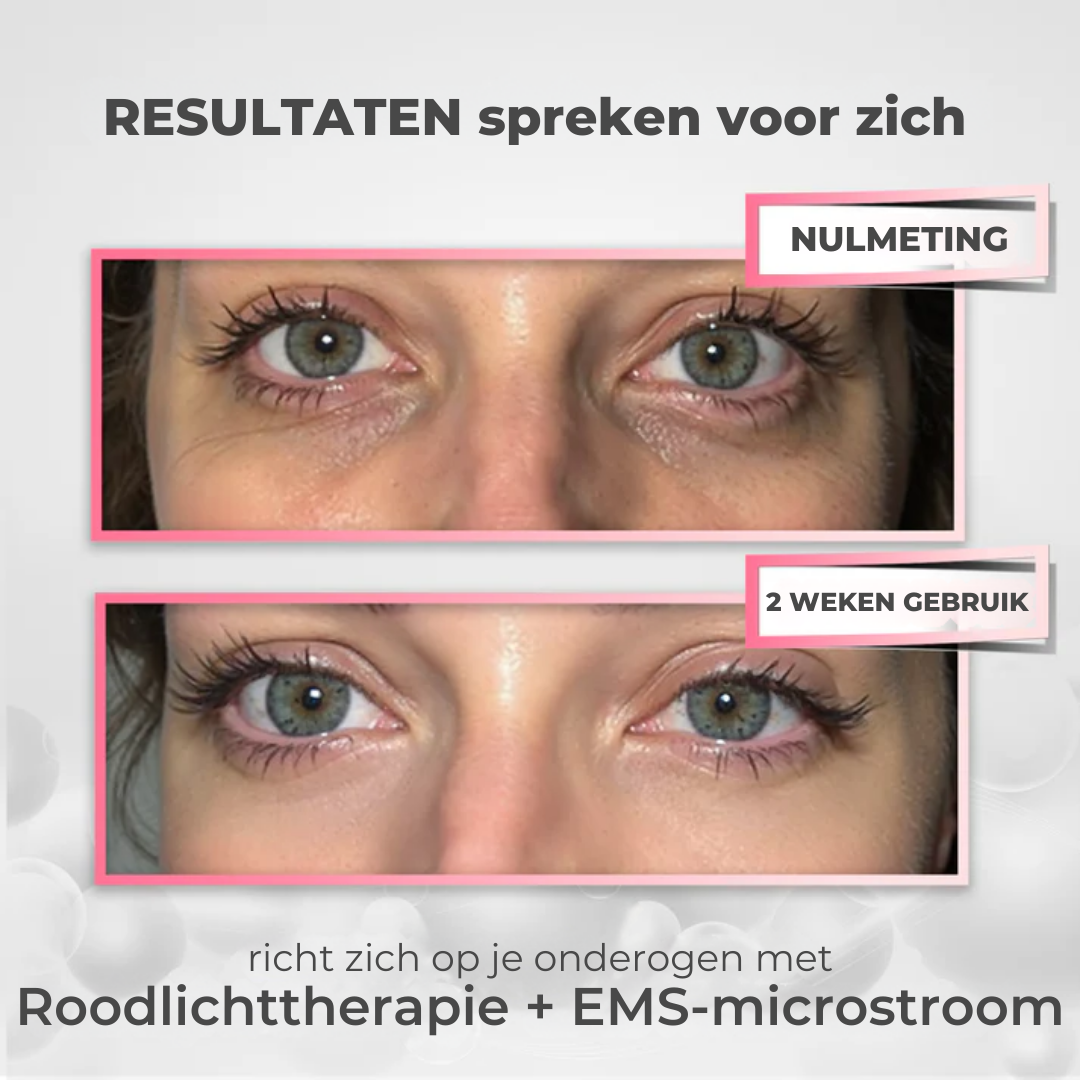 EyeClinic Under-Eye Serum verheldert en verstevigt de huid onder de ogen, vermindert donkere kringen, verzacht fijne lijntjes en rimpels en laat vermoeide ogen weer stralen. Deze anti-aging oogserum werkt snel en effectief in slechts 10 minuten per dag en zorgt voor een jeugdige, frisse uitstraling. Helpt bij het verminderen van wallen en het verbeteren van de huidstructuur rond de ogen voor een zichtbaar gladdere, stevigere huid.