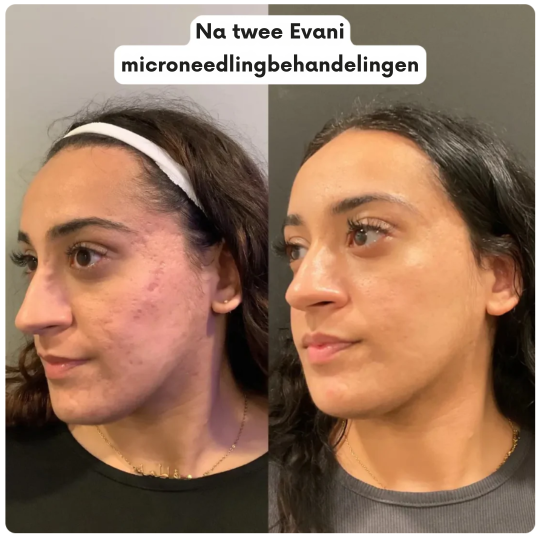 Hoogwaardig A8 Microneedling Pen-apparaat van Evani, strak handzaam ontwerp voor huidvernieuwing thuis. Bevat drie soorten steriele cartridges (12-pins voor diepe acnelittekens en rimpels, 36-pins voor volledige gezichtsverjonging, nano voor gevoelige zones), instelbare naalddiepte, medische precisie. Ontworpen om collageen en elastine te stimuleren, acne-littekens te vervagen, de huidtextuur te egaliseren, de teint te verbeteren en de opname van huidverzorgingsserums te bevorderen."