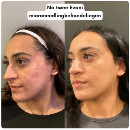 Hoogwaardig A8 Microneedling Pen-apparaat van Evani, strak handzaam ontwerp voor huidvernieuwing thuis. Bevat drie soorten steriele cartridges (12-pins voor diepe acnelittekens en rimpels, 36-pins voor volledige gezichtsverjonging, nano voor gevoelige zones), instelbare naalddiepte, medische precisie. Ontworpen om collageen en elastine te stimuleren, acne-littekens te vervagen, de huidtextuur te egaliseren, de teint te verbeteren en de opname van huidverzorgingsserums te bevorderen."