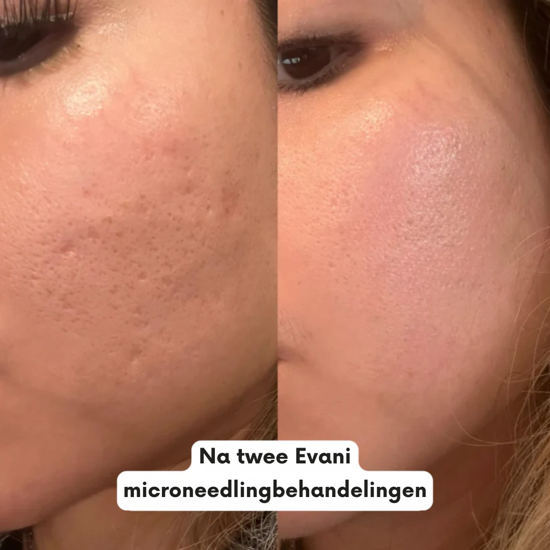 Hoogwaardig A8 Microneedling Pen-apparaat van Evani, strak handzaam ontwerp voor huidvernieuwing thuis. Bevat drie soorten steriele cartridges (12-pins voor diepe acnelittekens en rimpels, 36-pins voor volledige gezichtsverjonging, nano voor gevoelige zones), instelbare naalddiepte, medische precisie. Ontworpen om collageen en elastine te stimuleren, acne-littekens te vervagen, de huidtextuur te egaliseren, de teint te verbeteren en de opname van huidverzorgingsserums te bevorderen." 